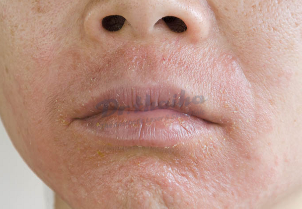 Lột da mặt bị đỏ và rát là bị làm sao? Cách khắc phục