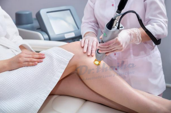 Triệt lông xong có cần kiêng nước không?