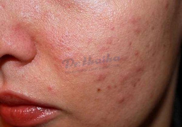 Da xấu sần sùi: Nguyên nhân và giải pháp giúp da đẹp hơn