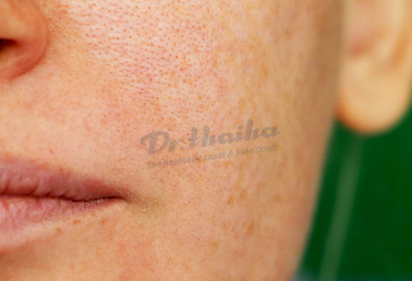 Da xấu sần sùi: Nguyên nhân và giải pháp giúp da đẹp hơn