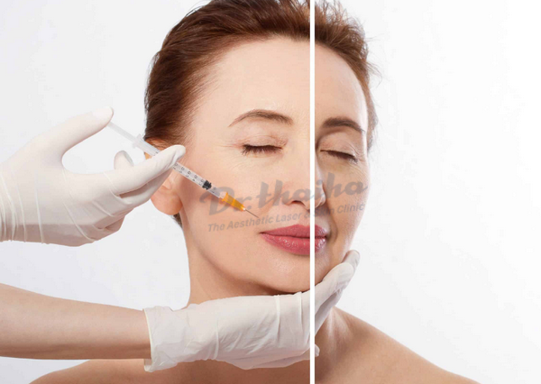 Tiêm HA face là gì? Phù hợp với ai? Ưu, nhược điểm