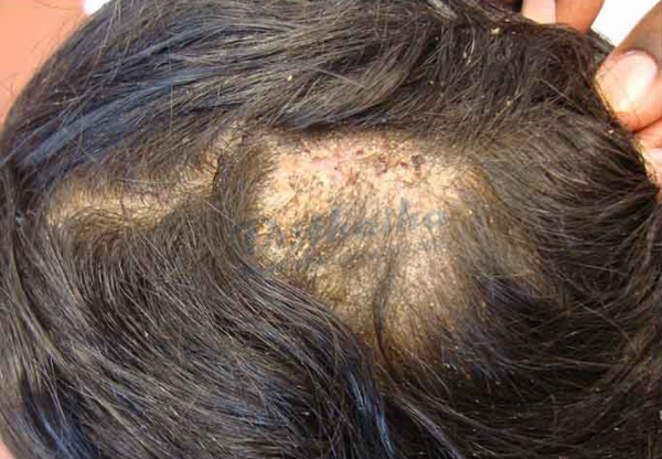 Chốc đầu là gì? Cách chữa trị như thế nào?