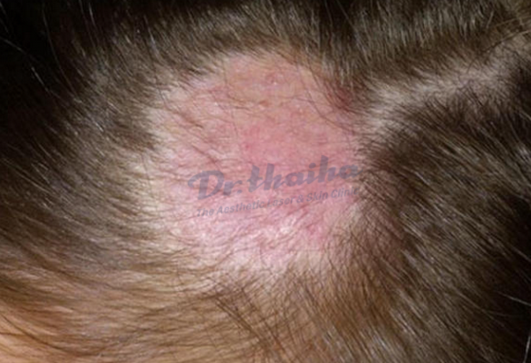 Chốc đầu là gì? Cách chữa trị như thế nào?