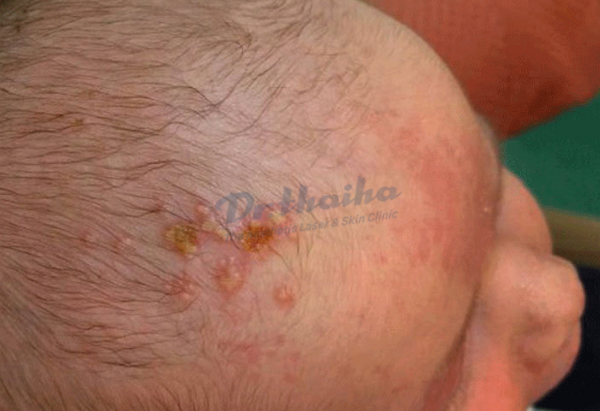 Chốc đầu là gì? Cách chữa trị như thế nào?