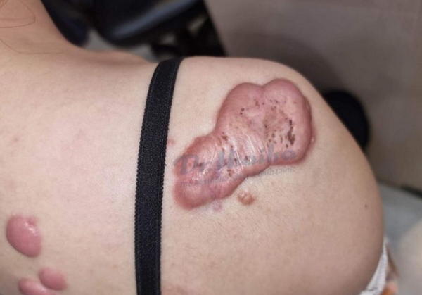 Phân biệt sẹo lồi và sẹo phì đại? Cách chữa trị hiệu quả