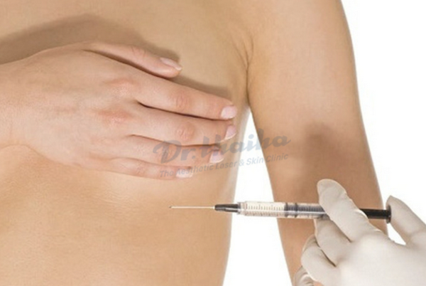 Tiêm filler ngực được bao lâu? Chuyên gia chia sẻ