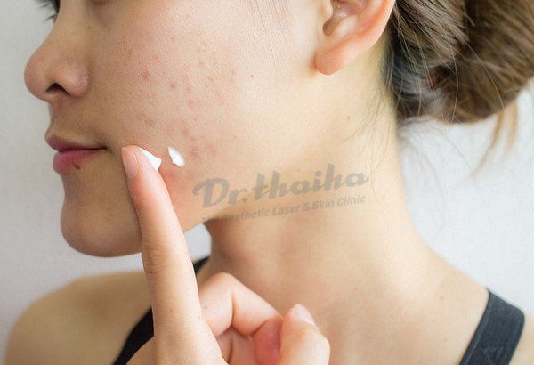 Trị mụn 1 tuần có khỏi được không? Chia sẻ từ chuyên gia