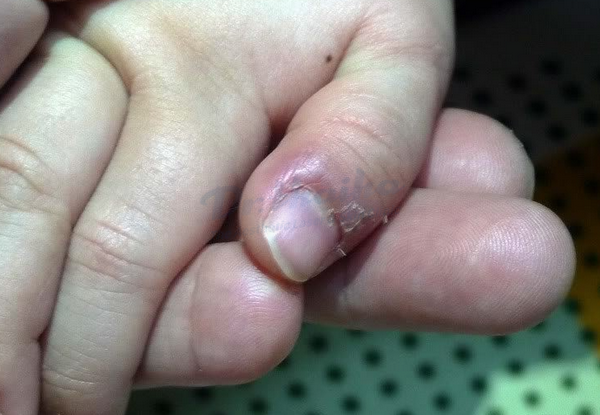 Xước măng rô ở ngón tay: Nguyên nhân và cách cải thiện