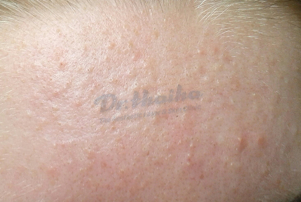 Bí quyết trị mụn ẩn bằng rau diếp cá, bác sĩ nói gì