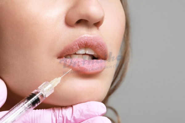 Tiêm filler bị phồng da có nguy hiểm không? Nguyên nhân và cách xử lý