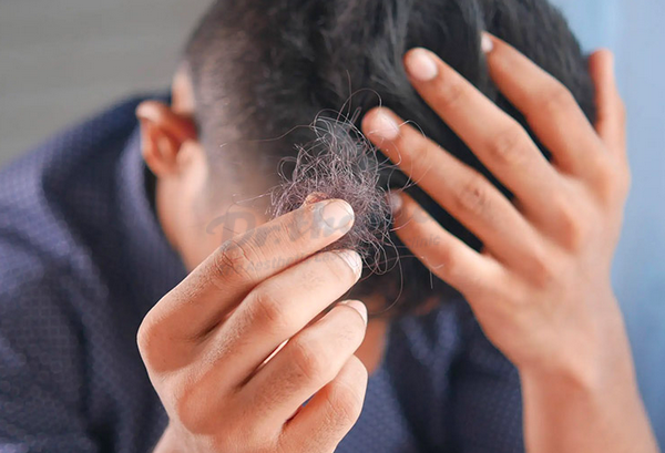 Tóc rụng quá nhiều khi gội đầu là bị làm sao?