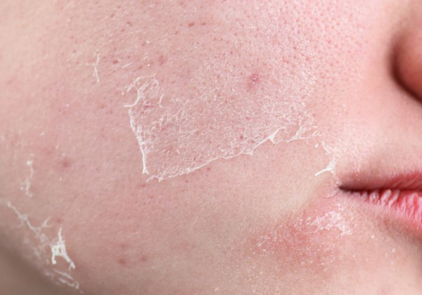 Da Nhạy Cảm Có Peel Được Không? Bác Sĩ Da Liễu Tư Vấn 