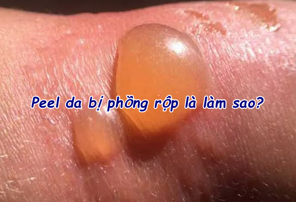 Hỏi đáp: Peel da bị phồng rộp là bị làm sao?