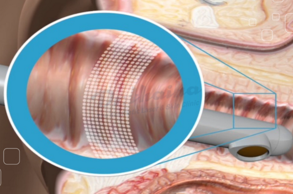 Trẻ hóa vùng kín bằng laser là gì? Công nghệ này có hiệu quả không