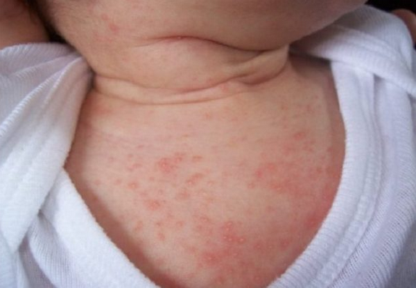 Mặc đồ len dạ bị nổi mẩn và ngứa là bị làm sao?