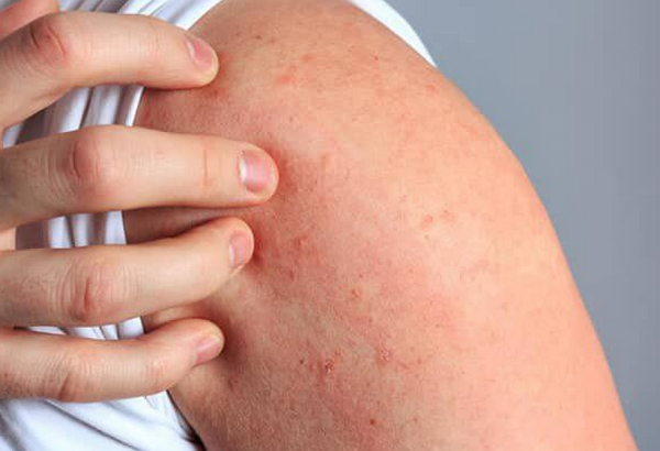 Mặc đồ len dạ bị nổi mẩn và ngứa là bị làm sao?