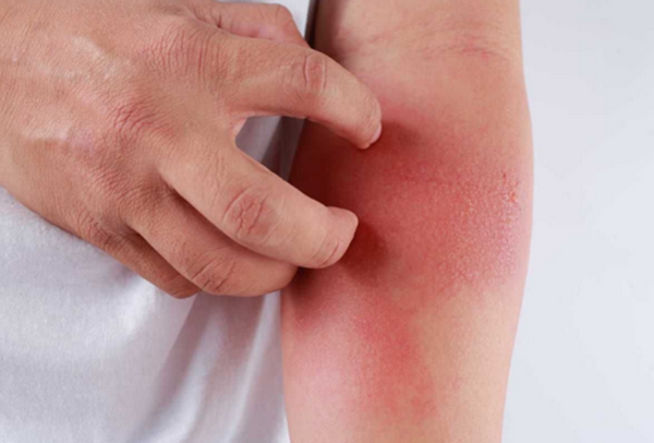 Viêm da cơ địa mùa hanh khô và cách cải thiện hiệu quả