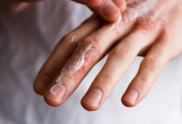 Viêm da cơ địa mùa hanh khô và cách cải thiện hiệu quả