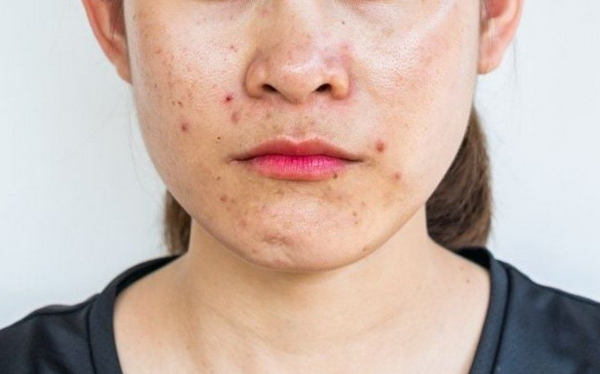 Da dầu có peel da được không? Cần lưu ý những gì?