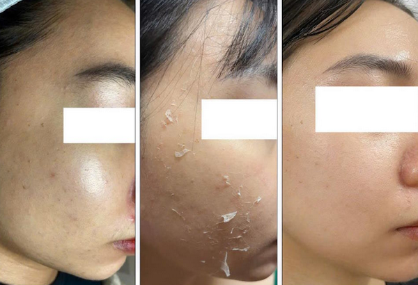 Da dầu có peel da được không? Cần lưu ý những gì?