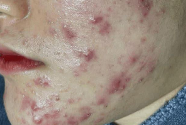 Da nổi mụn sau peel là bị làm sao? Cách phục hồi da sau peel hiệu quả