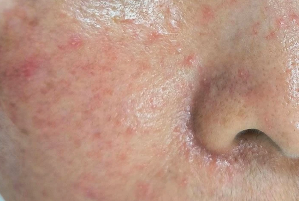 Hỏi đáp: Bị viêm nang lông peel da được không?