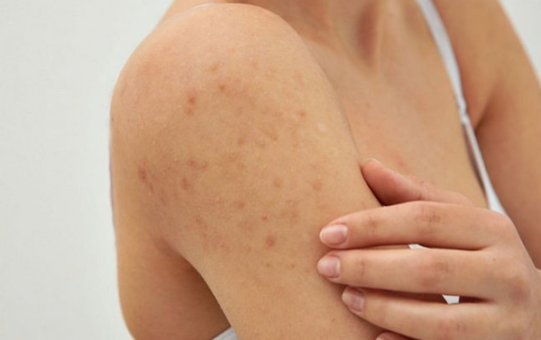 Hỏi đáp: Bị viêm nang lông peel da được không?