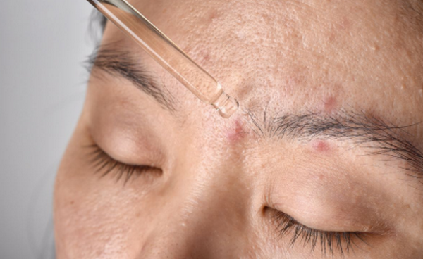 Hỏi đáp: Bôi serum bị nổi mụn do đâu