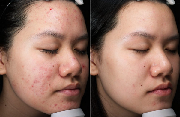 Hỏi đáp: Tại sao da bị thâm đỏ sau mụn? Có cần điều trị không?