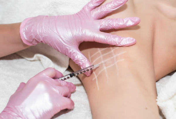 Đổ mồ hôi nách ra nhiều do đâu? Cách cải thiện là gì?