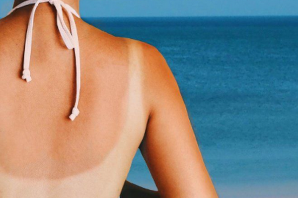 Hỏi đáp: Da bị cháy nắng bôi gì để cải thiện tự nhiên?