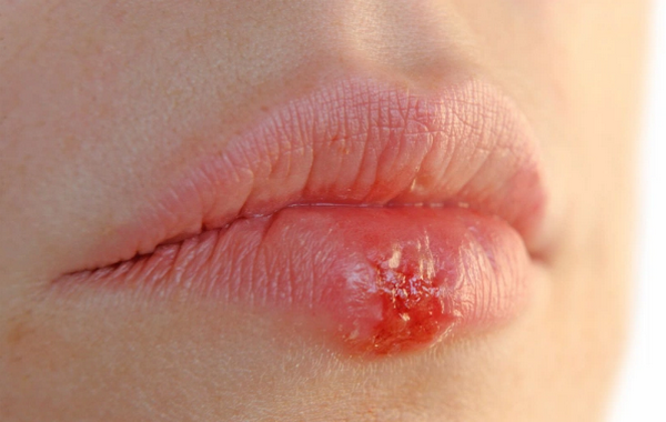 Hỏi đáp: Phun môi nổi mụn nước là bị làm sao?