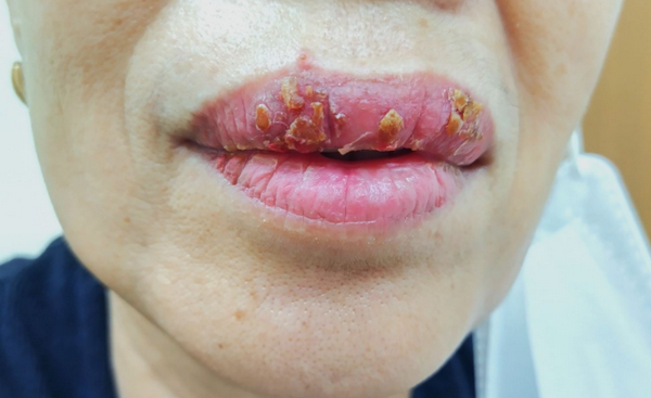 Hỏi đáp: Phun môi nổi mụn nước là bị làm sao?