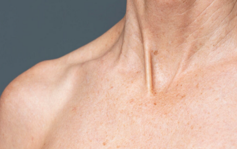 Ngấn cổ là gì? Cách giảm ngấn cổ an toàn và hiệu quả