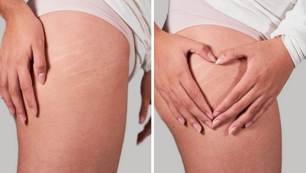 Rạn da bị ngứa có nên gãi không, xử lý như thế nào