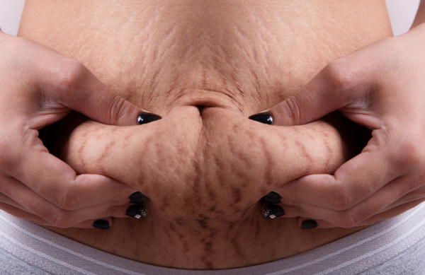 Rạn da có tự khỏi không, làm cách nào để cải thiện?