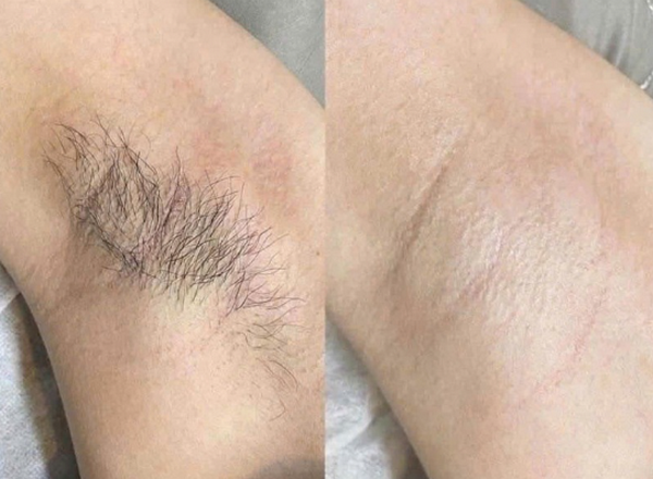 Triệt lông bị bỏng rát Nguyên nhân, dấu hiệu và cách xử lý