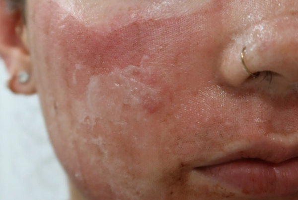 Chăm sóc da sau khi bắn laser giúp phục hồi nhanh