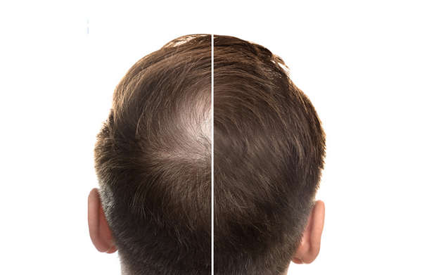 Chi phí khám rụng tóc bao nhiêu tiền? Khám ở đâu uy tín