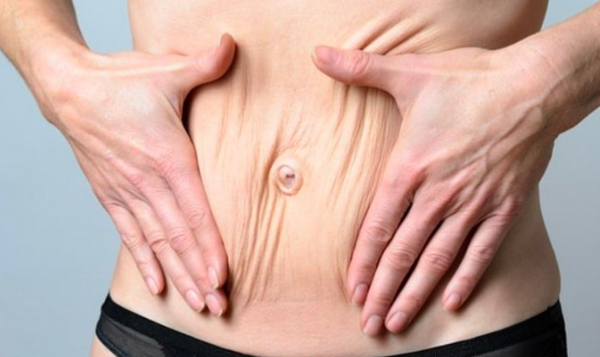 Da chảy xệ sau khi giảm cân do đâu, cách giúp da săn chắc hơn