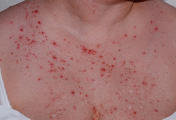 Nổi mụn trứng cá ở ngực có nguy hiểm không? Nguyên nhân và cách điều trị