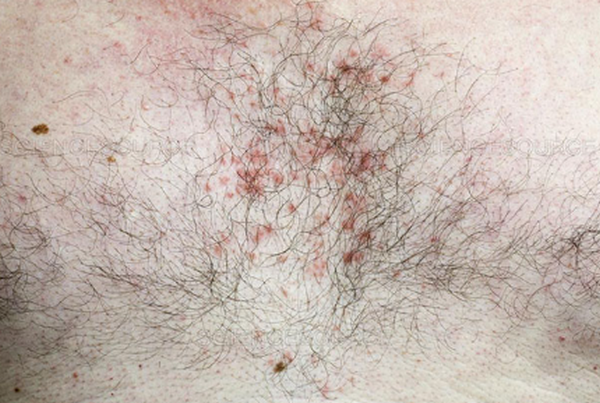 Nổi mụn trứng cá ở ngực có nguy hiểm không? Nguyên nhân và cách điều trị