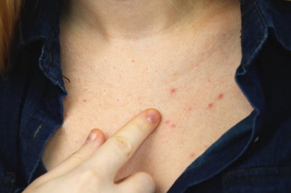 Nổi mụn trứng cá ở ngực có nguy hiểm không? Nguyên nhân và cách điều trị
