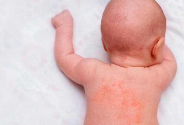 Sữa tắm cho trẻ viêm da cơ địa và cách chăm sóc da hiệu quả