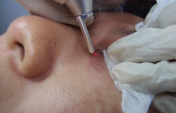 Bắn laser mụn thịt có hiệu quả không? 