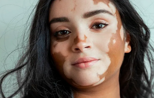 Da bị loang màu trắng có phải là bệnh không? 