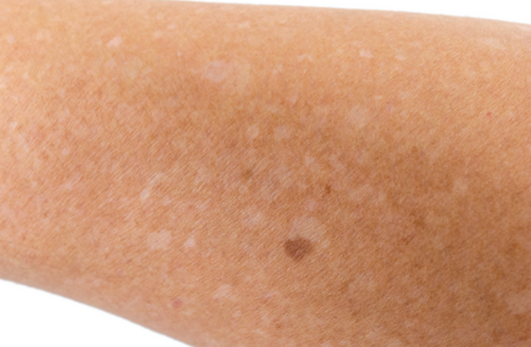 Da bị loang màu trắng có phải là bệnh không? 