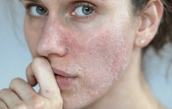 Da bị loang màu trắng có phải là bệnh không? 