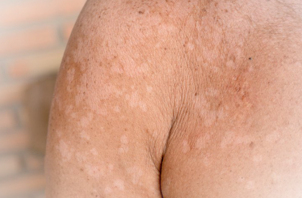 Da bị loang màu trắng có phải là bệnh không? 