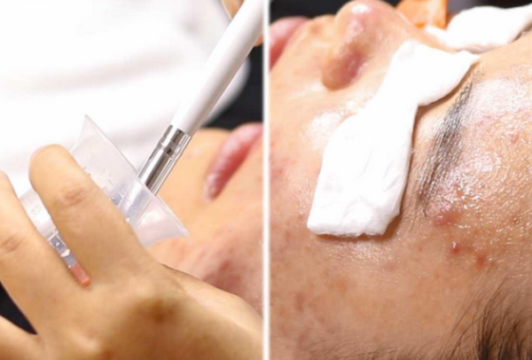 Hỏi đáp: Da đen có peel trắng được không?